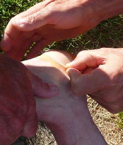 pose d'un compeed
